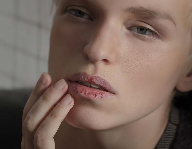 Vitamin Deficiency Causes Dry Lips?